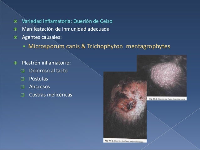 La achicoria a la psoriasis las revocaciones