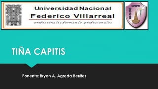 TIÑA CAPITIS
Ponente: Bryan A. Agreda Benites
 