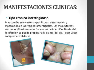 MANIFESTACIONES CLINICAS:
• Tipo crónico intertriginoso:
Mas común, se caracteriza por fisuras, descamación y
maceración en las regiones interdigitales. Las mas externas
son las localizaciones mas frecuentes de infección. Desde ahí
la infección se puede propagar a la planta del pie. Pocas veces
compromete el dorso.

 