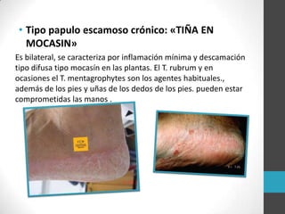 • Tipo papulo escamoso crónico: «TIÑA EN
MOCASIN»
Es bilateral, se caracteriza por inflamación mínima y descamación
tipo difusa tipo mocasín en las plantas. El T. rubrum y en
ocasiones el T. mentagrophytes son los agentes habituales.,
además de los pies y uñas de los dedos de los pies. pueden estar
comprometidas las manos .

 