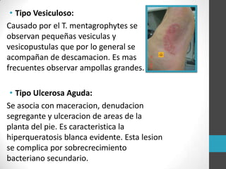 • Tipo Vesiculoso:
Causado por el T. mentagrophytes se
observan pequeñas vesiculas y
vesicopustulas que por lo general se
acompañan de descamacion. Es mas
frecuentes observar ampollas grandes.
• Tipo Ulcerosa Aguda:
Se asocia con maceracion, denudacion
segregante y ulceracion de areas de la
planta del pie. Es caracteristica la
hiperqueratosis blanca evidente. Esta lesion
se complica por sobrecrecimiento
bacteriano secundario.

 