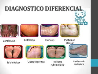 DIAGNOSTICO DIFERENCIAL

Candidiasis

Sd de Reiter

Eritrasma

Queratodermia

psoriasis

Pitiriasis
rubra pilaris

Pustulosis
plantar

Piodermitis
bacteriana

 