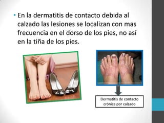 • En la dermatitis de contacto debida al
calzado las lesiones se localizan con mas
frecuencia en el dorso de los pies, no así
en la tiña de los pies.

Dermatitis de contacto
crónica por calzado

 