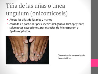 Tiña de las uñas o tinea
unguium (onicomicosis)
• Afecta las uñas de los pies y manos
• causada en particular por especies del género Trichophyton y,
salvo pocas excepciones, por especies de Microsporum y
Epidermophyton.
Onicomicosis, onicomicosis
dermatofítica.
 