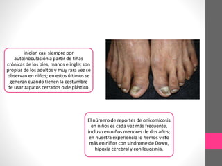 inician casi siempre por
autoinoculación a partir de tiñas
crónicas de los pies, manos e ingle; son
propias de los adultos y muy rara vez se
observan en niños; en estos últimos se
generan cuando tienen la costumbre
de usar zapatos cerrados o de plástico.
El número de reportes de onicomicosis
en niños es cada vez más frecuente,
incluso en niños menores de dos años;
en nuestra experiencia lo hemos visto
más en niños con síndrome de Down,
hipoxia cerebral y con leucemia.
 