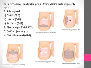 Las onicomicosis se dividen por su forma clínica en los siguientes
tipos:
1. Subungueal:
a) Distal (OSD)
b) Lateral (OSL)
c) Proximal (OSP)
2. Blanca superfi cial (PBS)
3. Endónix (endonyx)
4. Distrófi ca total (ODT)
 