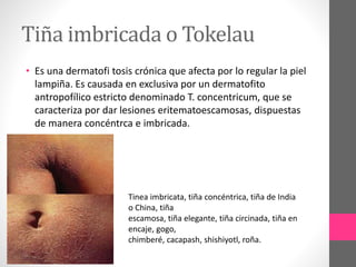 Tiña imbricada o Tokelau
• Es una dermatofi tosis crónica que afecta por lo regular la piel
lampiña. Es causada en exclusiva por un dermatofito
antropofílico estricto denominado T. concentricum, que se
caracteriza por dar lesiones eritematoescamosas, dispuestas
de manera concéntrca e imbricada.
Tinea imbricata, tiña concéntrica, tiña de India
o China, tiña
escamosa, tiña elegante, tiña circinada, tiña en
encaje, gogo,
chimberé, cacapash, shishiyotl, roña.
 