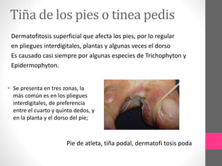 Tiña de los pies o tinea pedis
Dermatofitosis superficial que afecta los pies, por lo regular
en pliegues interdigitales, plantas y algunas veces el dorso
Es causado casi siempre por algunas especies de Trichophyton y
Epidermophyton.
Pie de atleta, tiña podal, dermatofi tosis poda
• Se presenta en tres zonas, la
más común es en los pliegues
interdigitales, de preferencia
entre el cuarto y quinto dedos, y
en la planta y el dorso del pie;
 