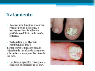 Tratamiento
• Realizar una limpieza mecánica
regular por un podólogo, o
incluso realizar la ablación
periódica o definitiva de la uña
enferma.
• Terbinafina oral (Lamisil
comp®), 250 mg/d
Tomar durante 2 meses para la
infección de las uñas de las manos
y durante 4 meses para las uñas de
los pies.
• Las lacas ungueales consiguen la
curación no superior al 10-15%
 