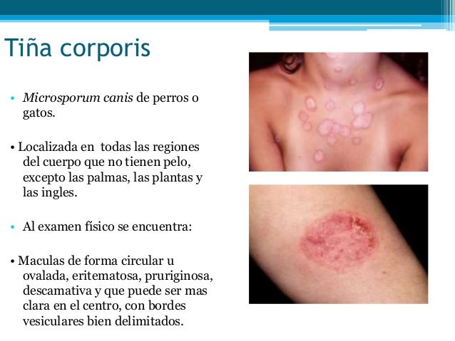 La eccema de la infección crónica