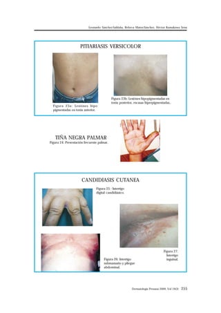 Leonardo Sánchez-Saldaña, Rebeca Matos-Sánchez, Héctor Kumakawa Sena 
PITIARIASIS VERSICOLOR 
Figura 23b: Lesiónes hipopigmentadas en 
toráx posterior, escasas hiperpigmentadas.. 
Dermatología Peruana 2009, Vol 19(3) 255 
Figura 23a: Lesiónes hipo 
pigmentadas en toráx anterior. 
TIÑA NEGRA PALMAR 
Figura 24: Presentación frecuente palmar. 
CANDIDIASIS CUTANEA 
Figura 25 : Interrigo 
digital candidiásico. 
Figura 26: Interrigo 
submamario y pliegue 
abdominal. 
Figura 27: 
Interrigo 
inguinal. 
 