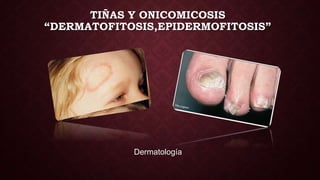 TIÑAS Y ONICOMICOSIS
“DERMATOFITOSIS,EPIDERMOFITOSIS”
Dermatología
 