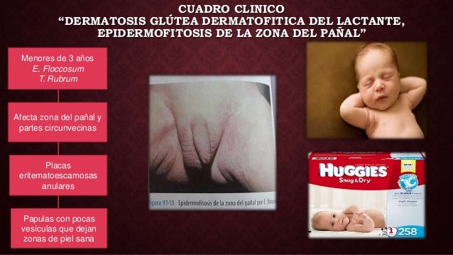 Bad para la psoriasis