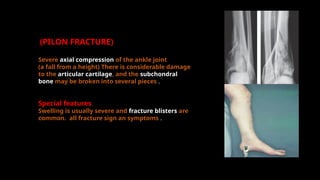tiba shaft fracture.pptx for presentation | PPTX