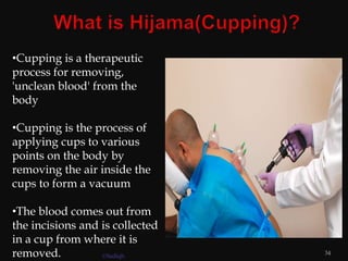 •Cupping is a therapeutic
process for removing,
'unclean blood' from the
body
•Cupping is the process of
applying cups to various
points on the body by
removing the air inside the
cups to form a vacuum
•The blood comes out from
the incisions and is collected
in a cup from where it is
removed. 34
©Sadiqh
 