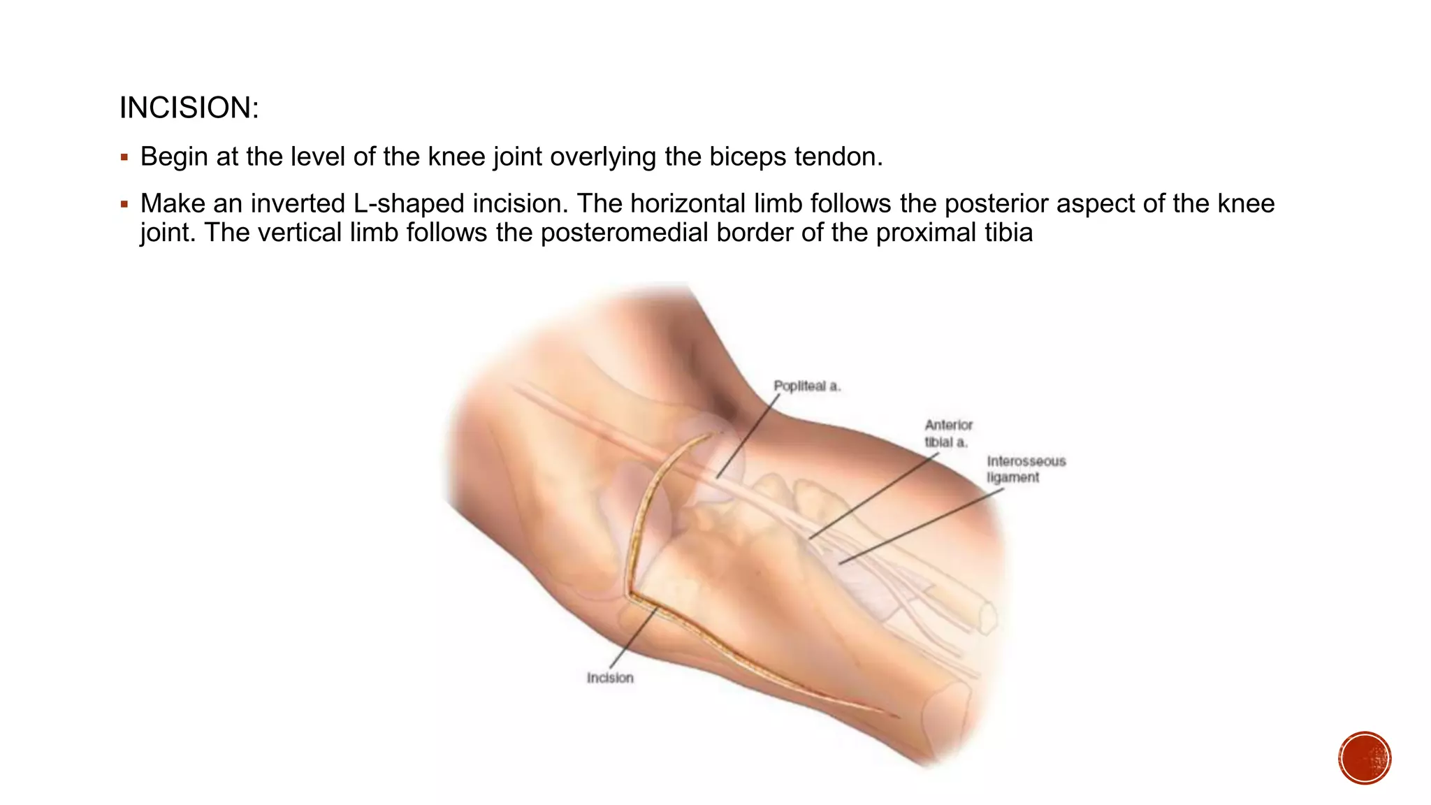 Proximal Tibia Surgical approaches | PPTX