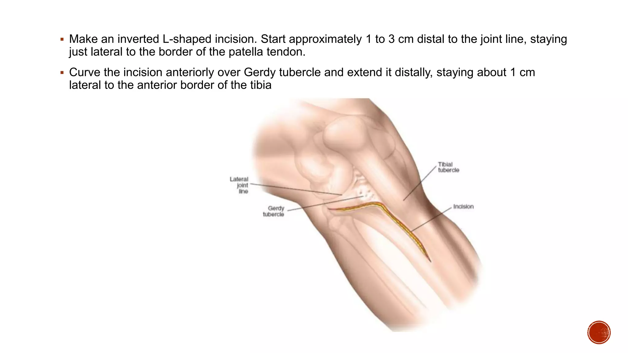 Proximal Tibia Surgical approaches | PPTX