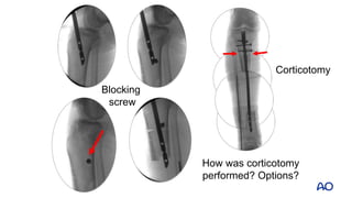 Tibia Defect Transportation Nail_Oct52018.pptx