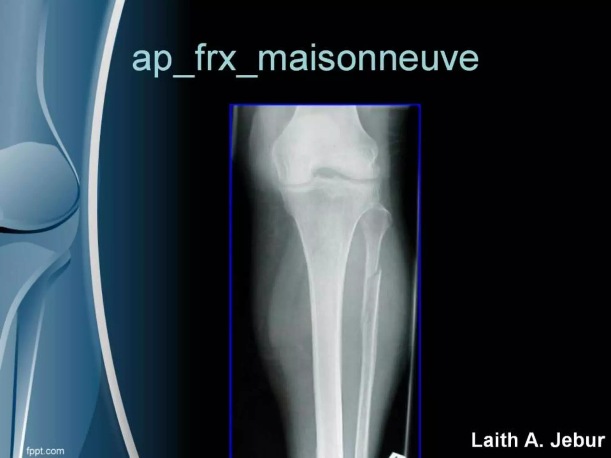 Orthopedics Of Tibia & fibula | PPT