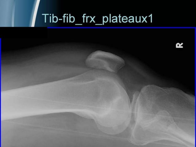 Orthopedics Of Tibia & fibula | PPT