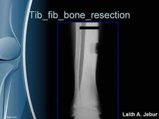Orthopedics Of Tibia & fibula | PPT