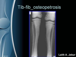 Orthopedics Of Tibia & fibula | PPT