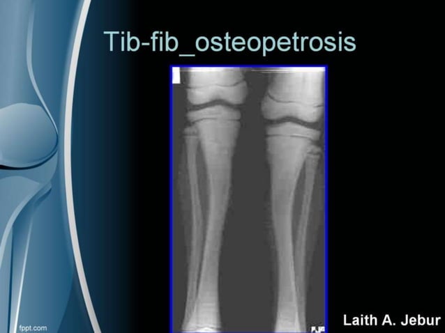 Orthopedics Of Tibia & fibula | PPT