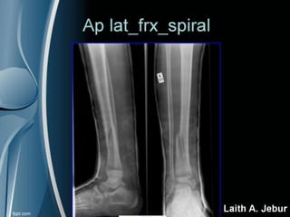 Orthopedics Of Tibia & fibula | PPT