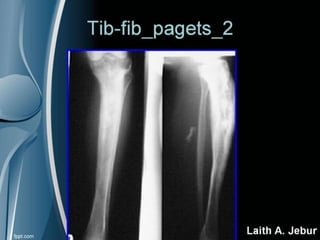 Tibia And Fibula X Ray