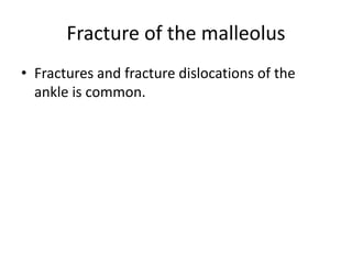 Fracture of the malleolus
• Fractures and fracture dislocations of the
ankle is common.
 