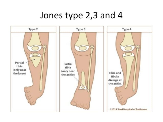 Tibial deficiency and Prosthetic management (part 1).pptx | Death ...