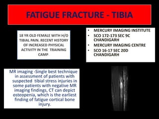 FATIGUE FRACTURE - TIBIA MERCURY IMAGING INSTITUTE  SCO 172-173 SEC 9C  CHANDIGARH MERCURY IMAGING CENTRE  SCO 16-17 SEC 20D CHANDIGARH 18 YR OLD FEMALE WITH H/O TIBIAL PAIN. RECENT HISTORY OF INCREASED PHYSICAL ACTIVITY IN THE  TRAINING CAMP.    MR imaging -Single best technique in assessment of patients with suspected  tibial stress injuries in some patients with negative MR imaging findings, CT can depict osteopenia, which is the earliest finding of fatigue cortical bone injury.  