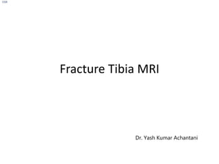 Fracture Tibia MRI
OSR
Dr. Yash Kumar Achantani
 