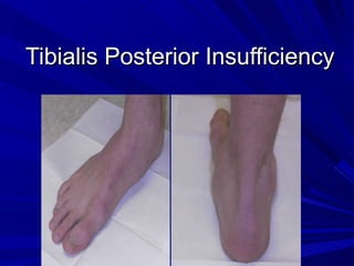 Tibialis Posterior Insufficiency 