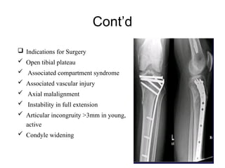 TIBIAL PLATEAU fracture power point presentation | PPTX