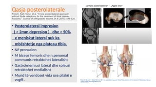 Tibial plateau fracture. Frakturat e plato tibise pptx | PPTX