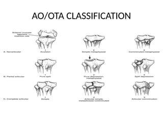tibial plateau fracture and its management.pptx