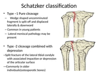 Scthker Classification tibial plateau fracture and its management.pptx