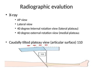 Traction Internal Rotation View tibial plateau fracture and its management.pptx