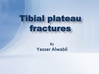 Tibial plateau
fractures
By

Yasser Alwabli

 