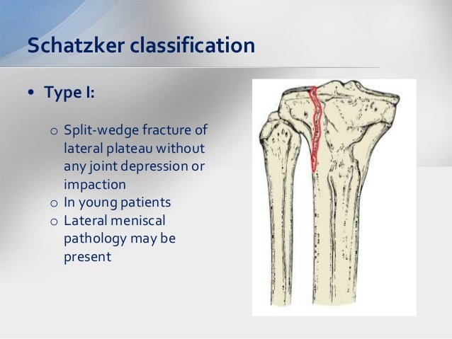 Tibial Plateau Fractures