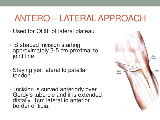 Tibial Plateau Fractures Tibial Plateau Fractures
