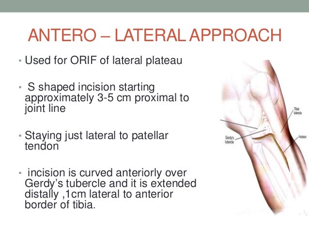 Tibial Plateau Fractures