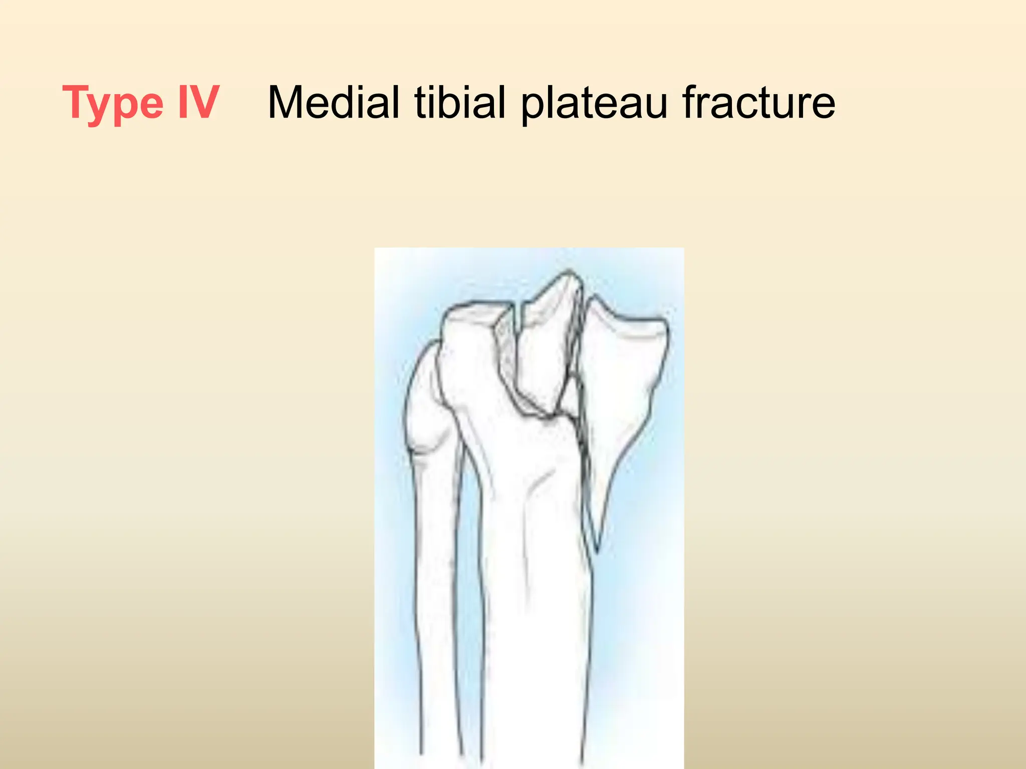 Tibial plateau fracture management .pptx
