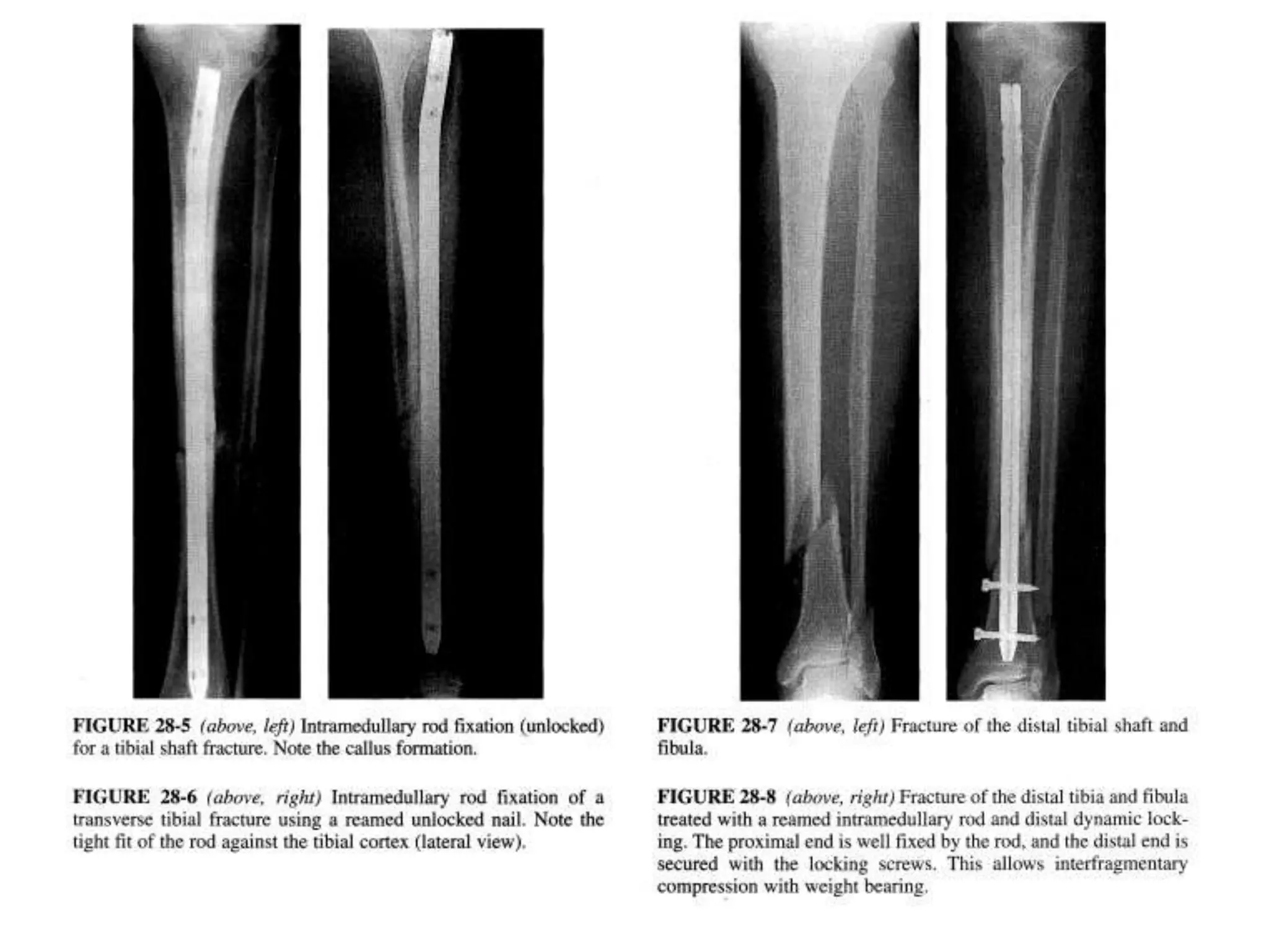 Tibia Ortho Tibial shaft fractures rehabilitation | PPTX