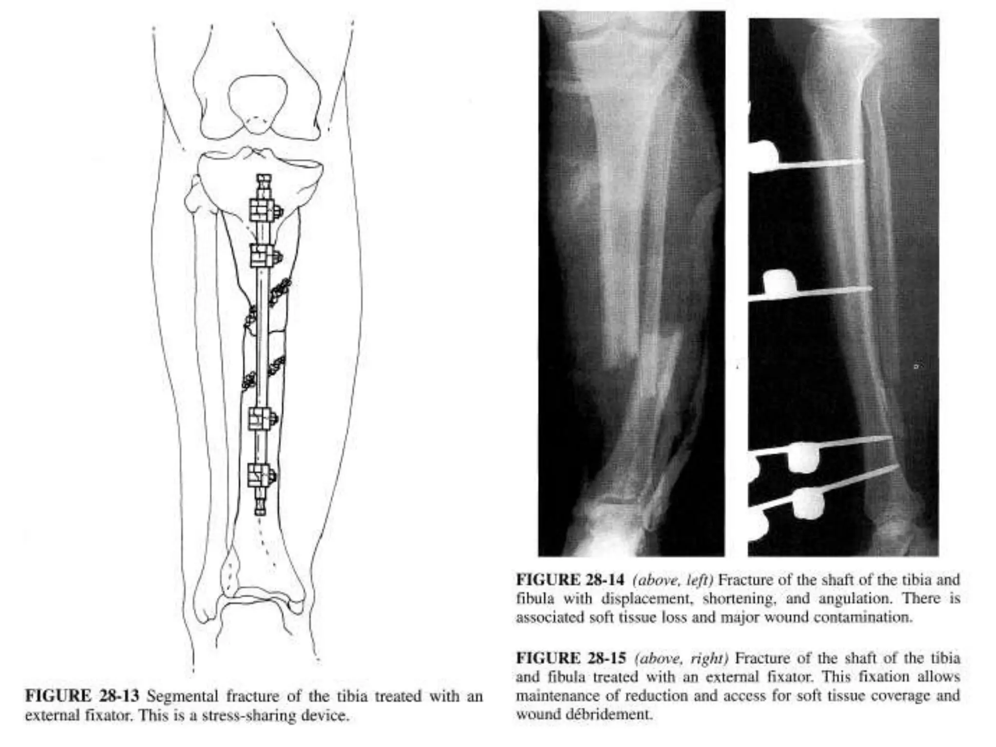 Tibia Ortho Tibial shaft fractures rehabilitation | PPTX