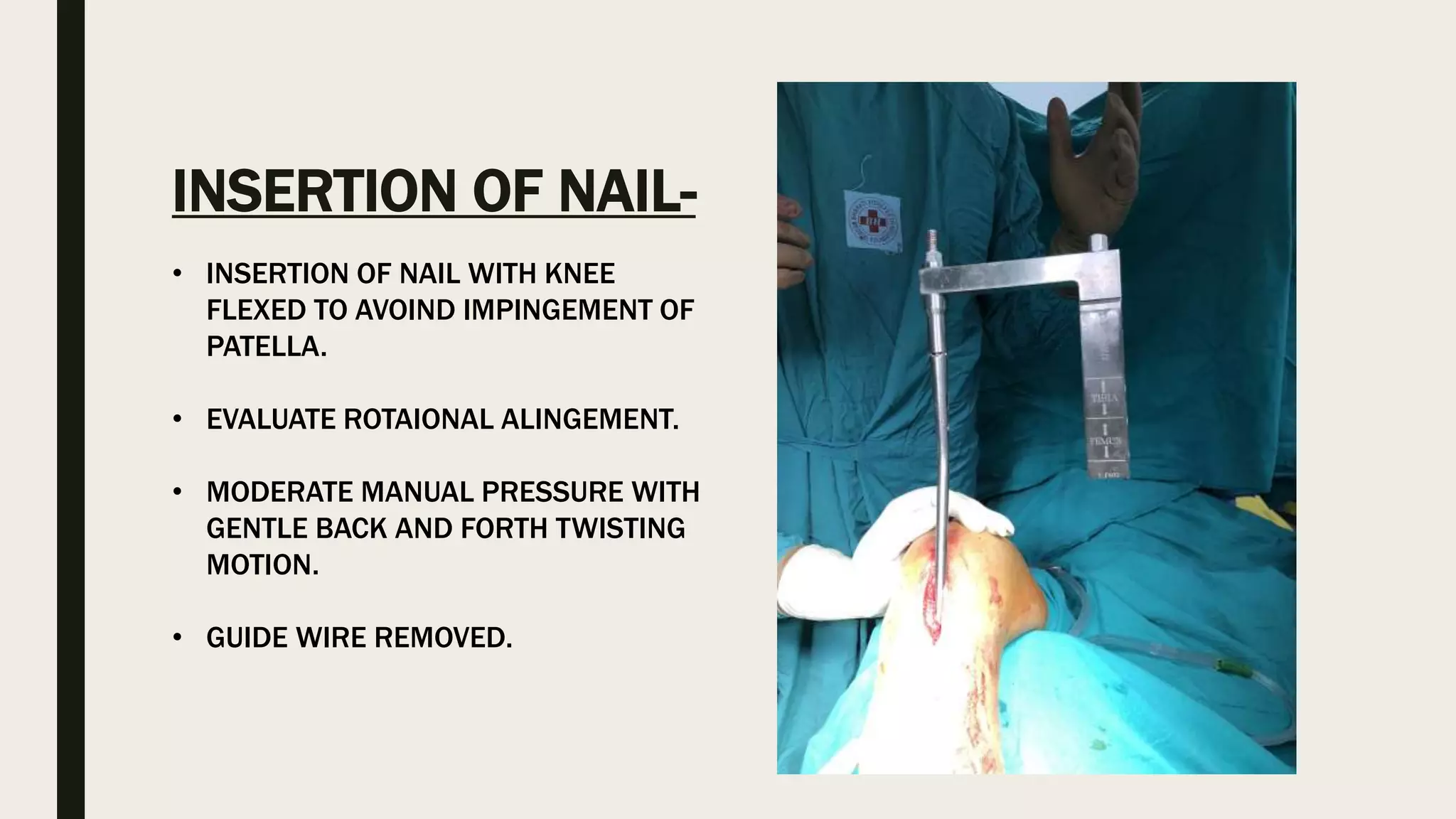 INSERTION OF NAIL-
• INSERTION OF NAIL WITH KNEE
FLEXED TO AVOIND IMPINGEMENT OF
PATELLA.
• EVALUATE ROTAIONAL ALINGEMENT.
• MODERATE MANUAL PRESSURE WITH
GENTLE BACK AND FORTH TWISTING
MOTION.
• GUIDE WIRE REMOVED.
 