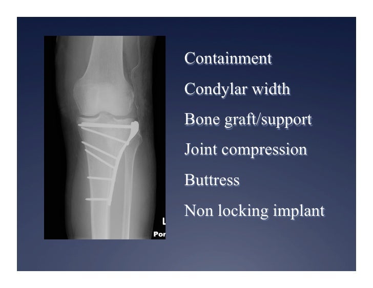 Tibia Plateu Shaft And Plafond Fractures 2012 Tibia Plateu Shaft And Plafond Fractures 2012