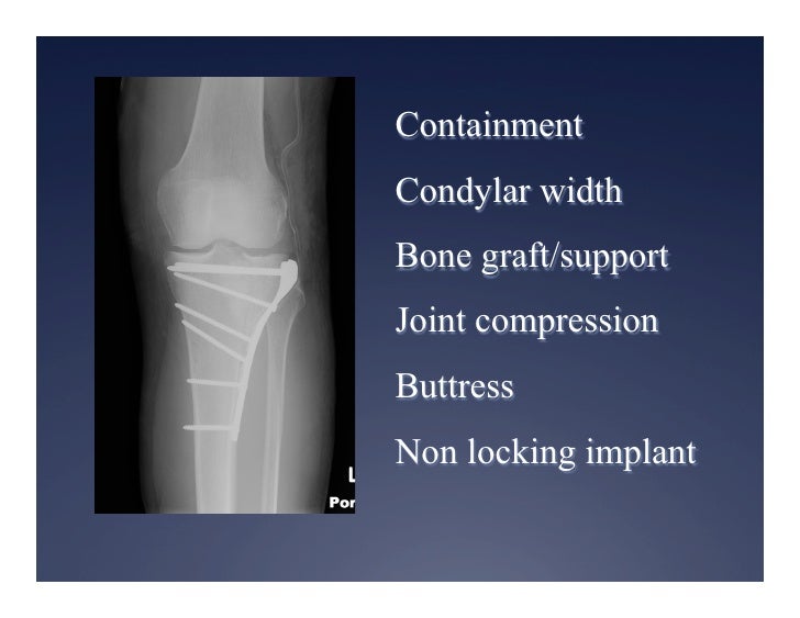 Tibia Plateu Shaft And Plafond Fractures 2012