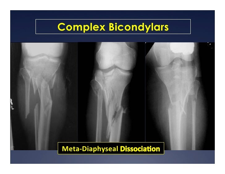 Tibia Plateu Shaft And Plafond Fractures 2012 Tibia Plateu Shaft And Plafond Fractures 2012